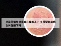 寻常型银屑病主要在膝盖上下 寻常型银屑病会长在腋下吗