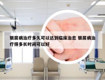 银屑病治疗多久可以达到临床治愈 银屑病治疗得多长时间可以好