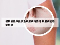 银屑病能不能根治银屑病传染吗 银屑病能不能根除