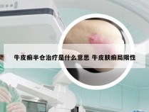 牛皮癣半仓治疗是什么意思 牛皮肤癣局限性