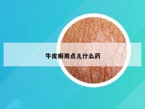 牛皮癣用点儿什么药