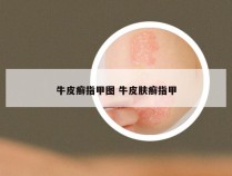 牛皮癣指甲图 牛皮肤癣指甲