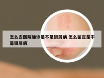 怎么去医院确诊是不是银屑病 怎么鉴定是不是银屑病