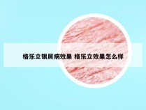 格乐立银屑病效果 格乐立效果怎么样