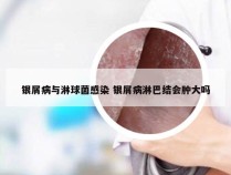 银屑病与淋球菌感染 银屑病淋巴结会肿大吗