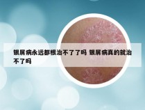 银屑病永远都根治不了了吗 银屑病真的就治不了吗