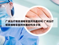 广州治疗银屑病哪家医院效果好吗 广州治疗银屑病哪家医院效果好吗多少钱