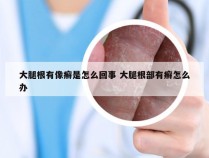 大腿根有像癣是怎么回事 大腿根部有癣怎么办