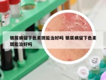 银屑病留下色素斑能治好吗 银屑病留下色素斑能治好吗