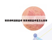 银屑病喝酒膝盖疼 银屑病膝盖疼是怎么回事