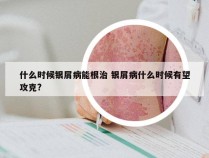 什么时候银屑病能根治 银屑病什么时候有望攻克?