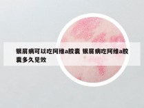 银屑病可以吃阿维a胶囊 银屑病吃阿维a胶囊多久见效