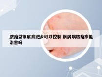 脓疱型银屑病跑步可以控制 银屑病脓疱疹能治愈吗