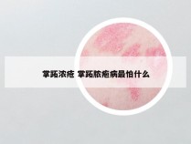 掌跖浓疮 掌跖脓疱病最怕什么