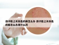 孩子脸上长白色的癣怎么办 孩子脸上长白色的癣怎么办用什么药