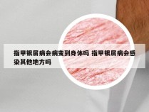 指甲银屑病会病变到身体吗 指甲银屑病会感染其他地方吗