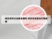 绿豆汤可以治银肖病吗 绿豆汤泡澡治疗银屑病