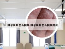 脖子长癣怎么回事 脖子长癣怎么回事图片