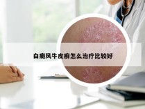 白癜风牛皮癣怎么治疗比较好