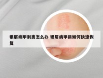 银屑病甲剥离怎么办 银屑病甲损如何快速恢复