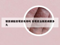 银屑病输青霉素有用吗 青霉素治银屑病要多久