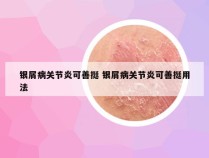 银屑病关节炎可善挺 银屑病关节炎可善挺用法