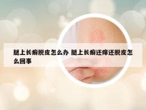 腿上长癣脱皮怎么办 腿上长癣还痒还脱皮怎么回事