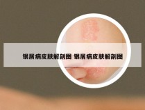 银屑病皮肤解剖图 银屑病皮肤解剖图