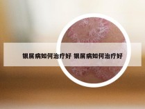 银屑病如何治疗好 银屑病如何治疗好