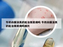 牛奶白膜涂真的能治银屑病吗 牛奶白膜涂真的能治银屑病吗图片