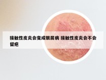 接触性皮炎会变成银屑病 接触性皮炎会不会留疤