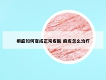 癣底如何变成正常皮肤 癣皮怎么治疗