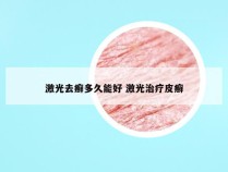 激光去癣多久能好 激光治疗皮癣