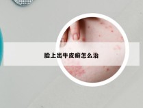 脸上出牛皮癣怎么治