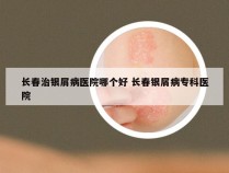 长春治银屑病医院哪个好 长春银屑病专科医院