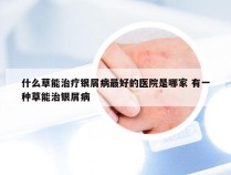 什么草能治疗银屑病最好的医院是哪家 有一种草能治银屑病