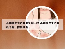 小孩嘴皮下边有出了癣一样 小孩嘴皮下边有出了癣一样的红点