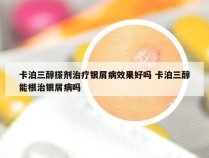 卡泊三醇搽剂治疗银屑病效果好吗 卡泊三醇能根治银屑病吗