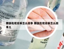 腰部出现皮癣怎么回事 腰部出现皮癣怎么回事儿