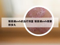 银屑病uvb的治疗剂量 银屑病uvb需要照多久