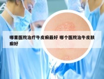 哪里医院治疗牛皮癣最好 哪个医院治牛皮肤癣好