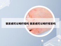 银屑病可以喝柠檬吗 银屑病可以喝柠檬茶吗