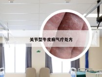 关节型牛皮癣气疗处方