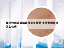 如何诊断银屑病是否是关节型 关节型银屑病怎么检查