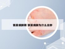 银屑病脚跟 银屑病脚为什么会肿