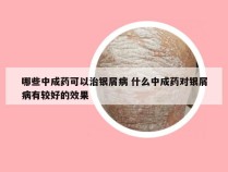 哪些中成药可以治银屑病 什么中成药对银屑病有较好的效果