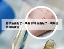 脖子后面起了一块癣 脖子后面起了一块癣还会结痂脱落