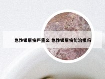 急性银屑病严重么 急性银屑病能治根吗