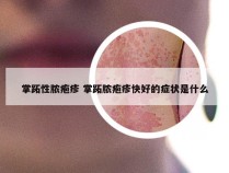 掌跖性脓疱疹 掌跖脓疱疹快好的症状是什么