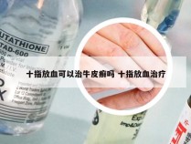 十指放血可以治牛皮癣吗 十指放血治疗